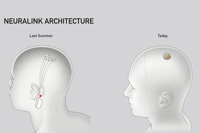 [Vidéo]: Elon Musk dévoile des implants neuronaux pour lutter contre les maladies neurologiques