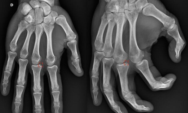 Levée de fonds de 8M€ pour La start-up Milvue et son logiciel d’aide au diagnostic radiologique