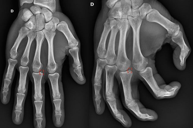 Levée de fonds de 8M€ pour La start-up Milvue et son logiciel d’aide au diagnostic radiologique